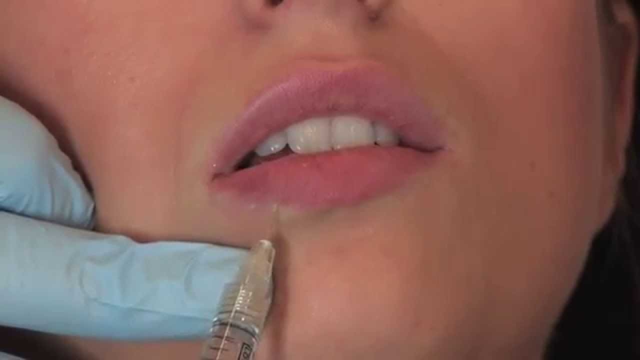 Perfekte Lippen mit juvederm lippen – Jetzt online entdecken